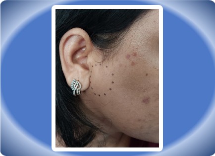 PAROTID TUMOUR